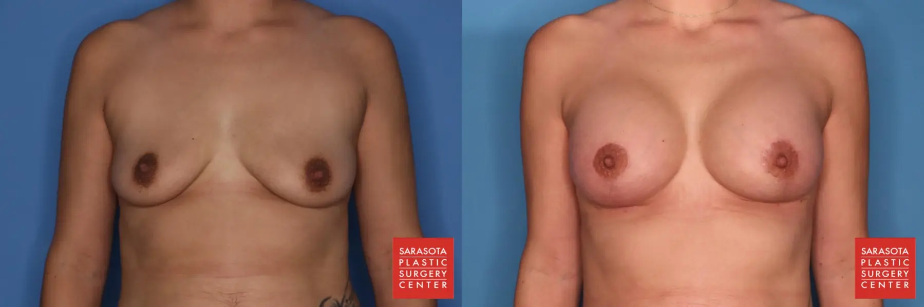 Breast Augmentation With Lift: Patient 7 - Before and After  