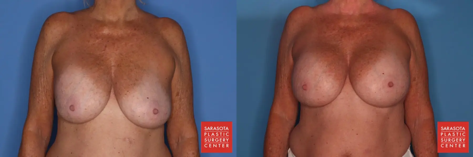 Breast Implant Exchange: Patient 2 - Before and After  