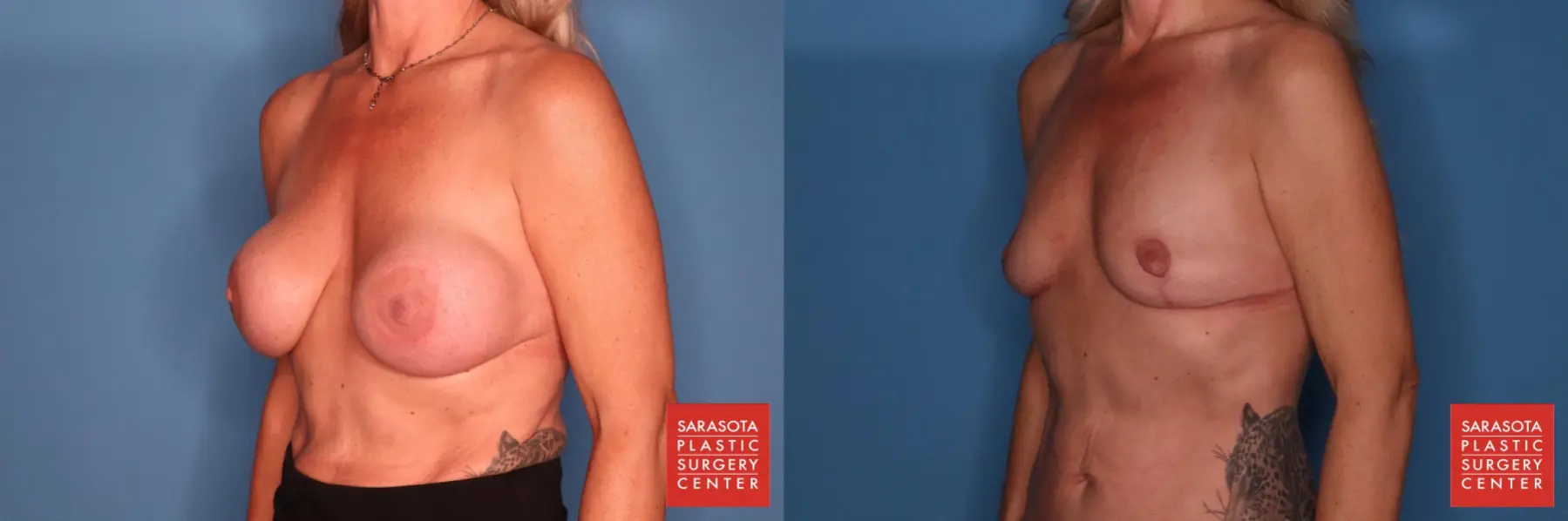 Breast Implant Removal With Lift: Patient 1 - Before and After 2
