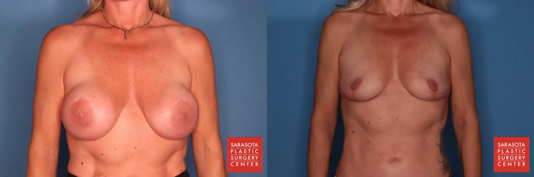 Breast Implant Removal With Lift: Patient 1 - Before and After  