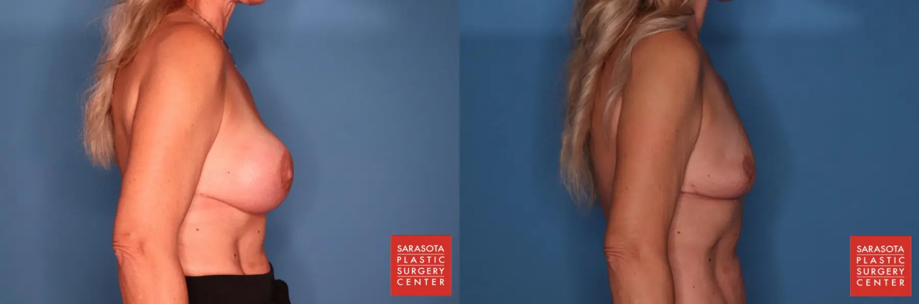 Breast Implant Removal With Lift: Patient 1 - Before and After 5