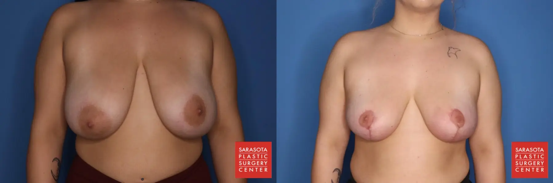 Breast Reduction: Patient 1 - Before and After  