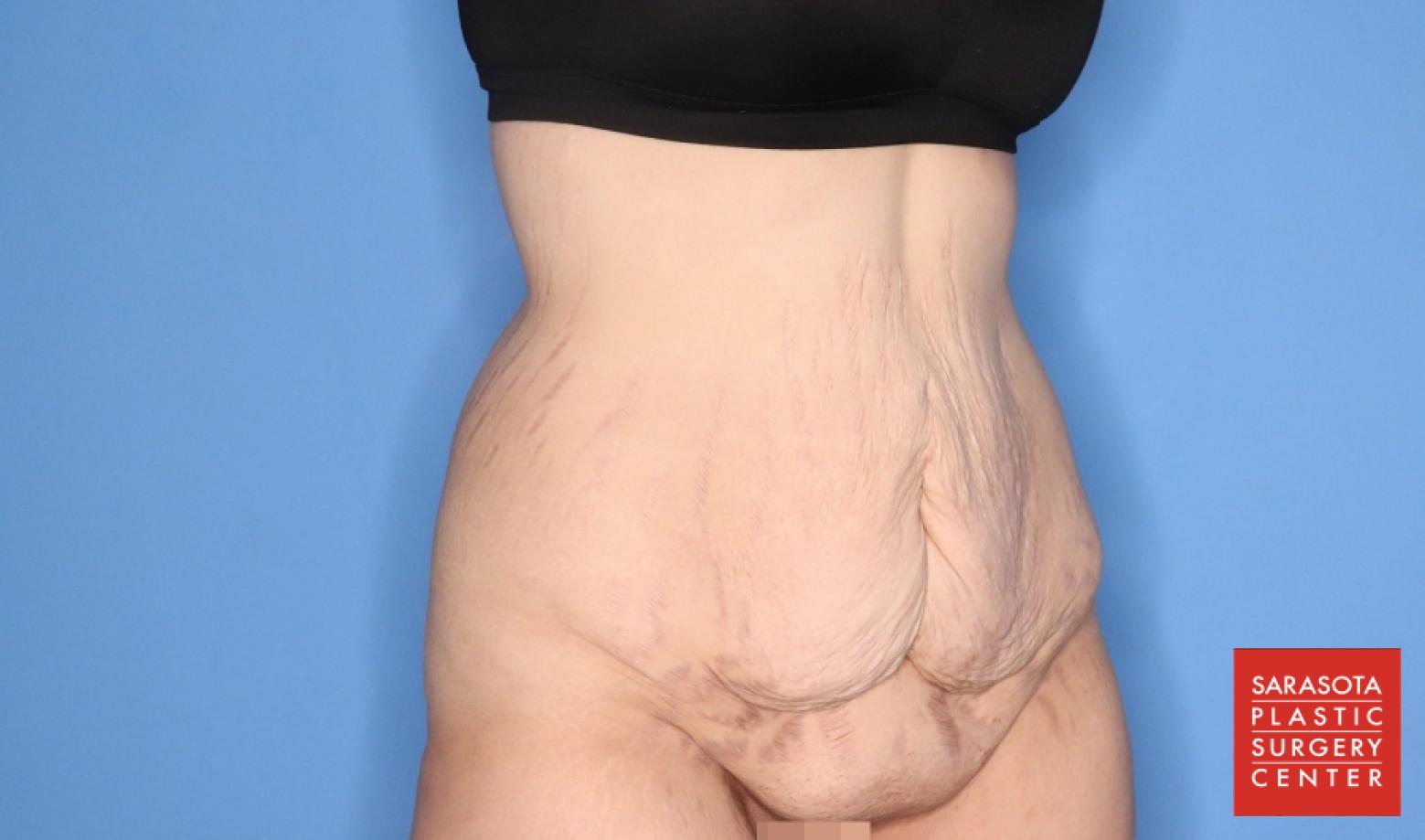 Abdominoplasty: Patient 3 - Before 2