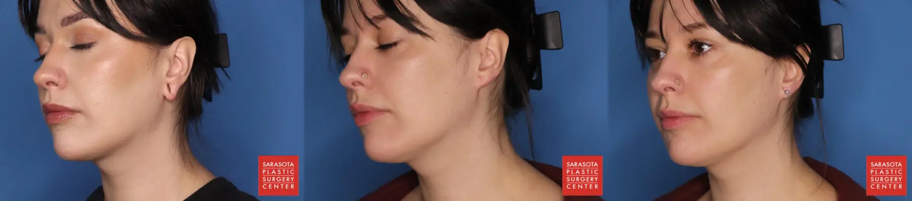 Earlobe Surgery: Patient 2 - Before and After  