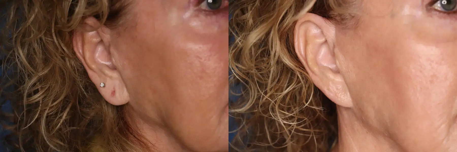 Earlobe Surgery: Patient 1 - Before and After  