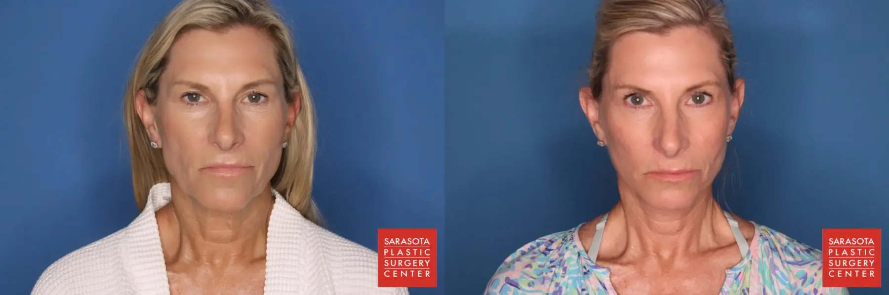 Facelift: Patient 1 - Before and After  