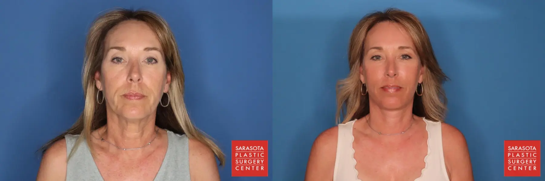 Facelift: Patient 2 - Before and After  