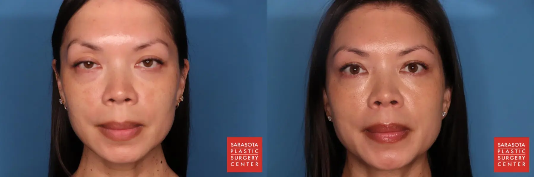 Fat Transfer - Face: Patient 1 - Before and After  