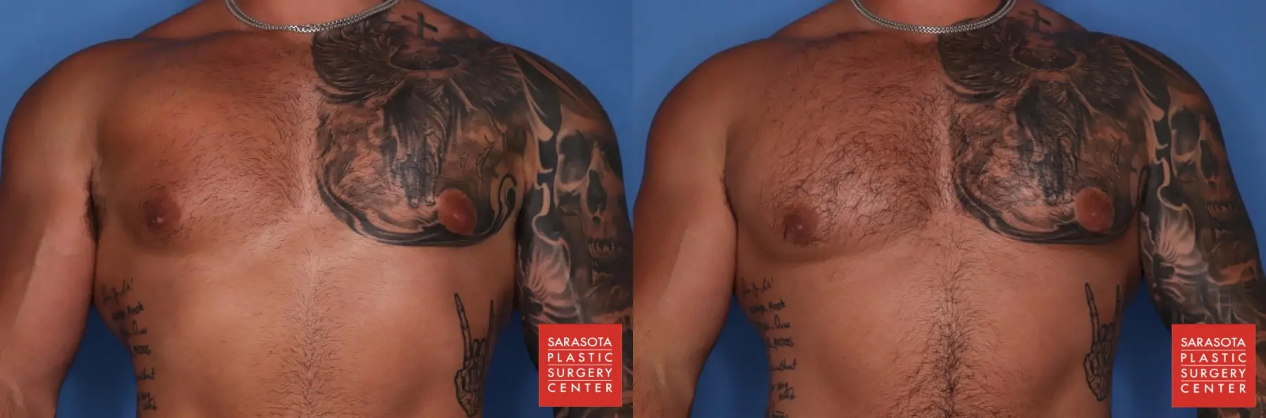 Gynecomastia: Patient 3 - Before and After  