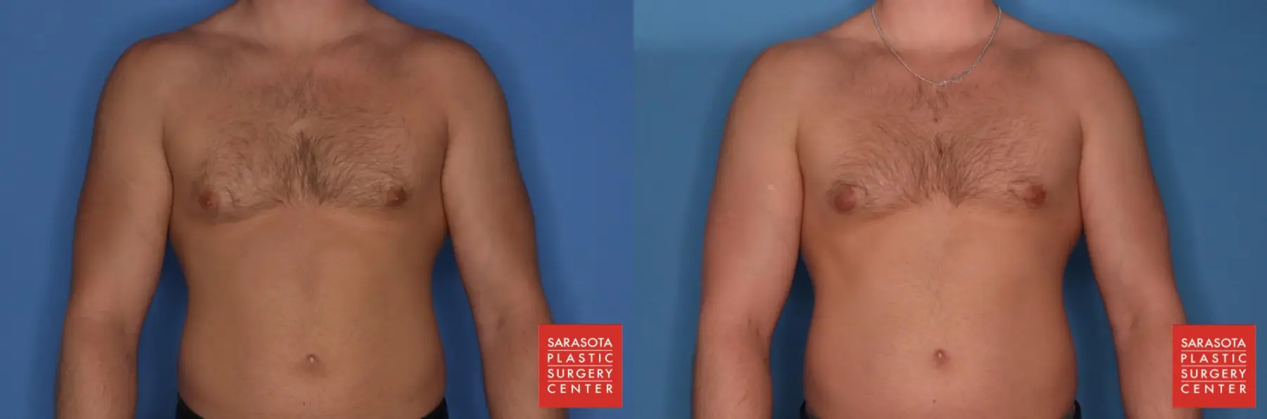 Gynecomastia: Patient 2 - Before and After  