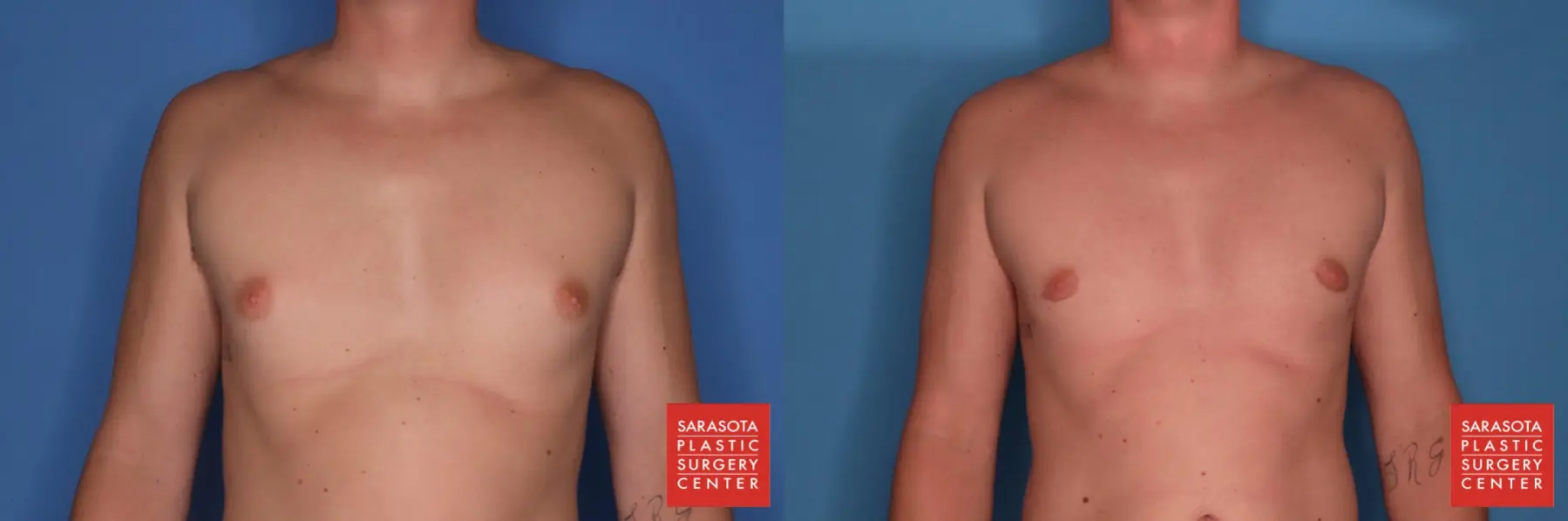 Gynecomastia: Patient 3 - Before and After  