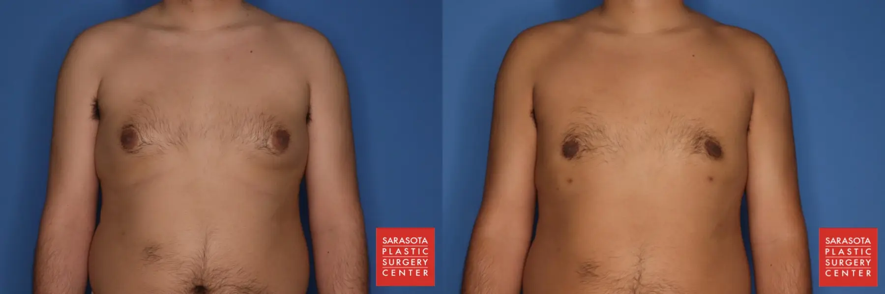 Gynecomastia: Patient 2 - Before and After  