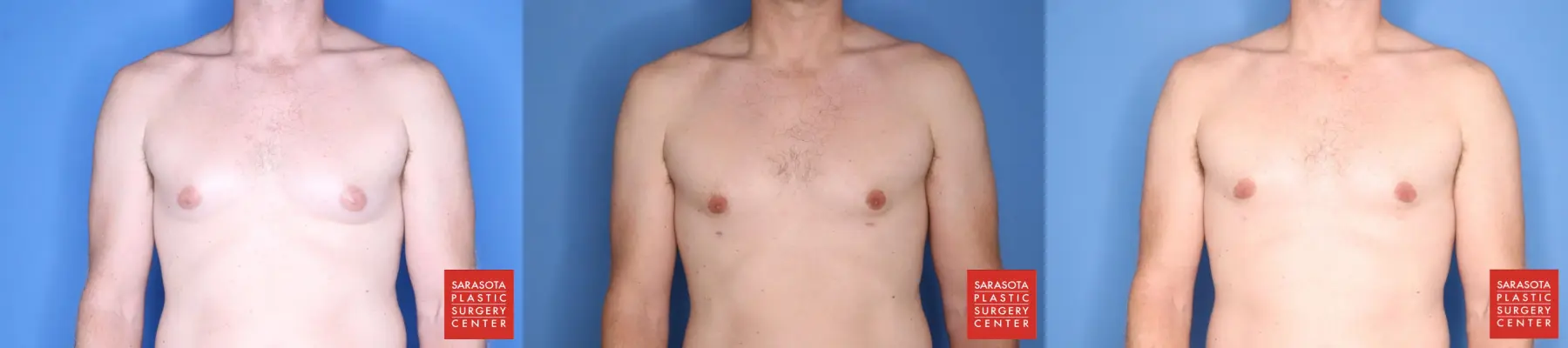Gynecomastia: Patient 1 - Before and After  