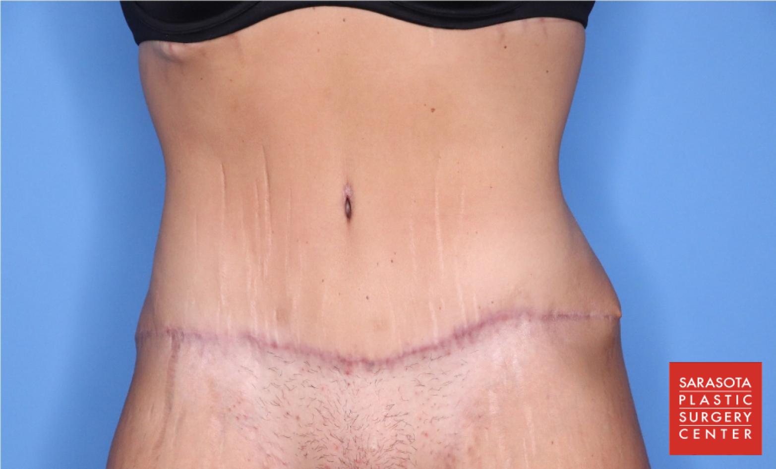 Abdominoplasty: Patient 4 - After  