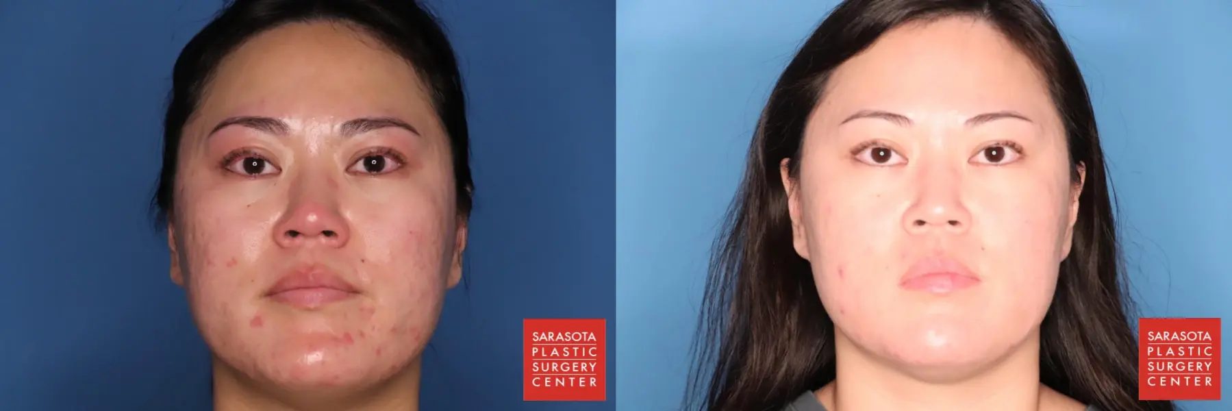 Laser Skin Resurfacing: Patient 1 - Before and After  