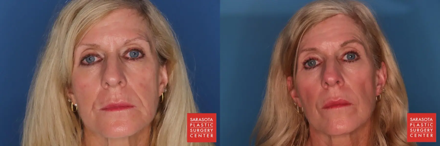 Laser Skin Resurfacing: Patient 2 - Before and After  
