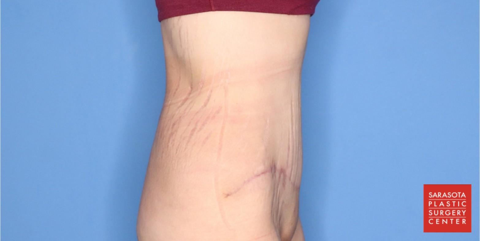 Abdominoplasty: Patient 3 - After 3