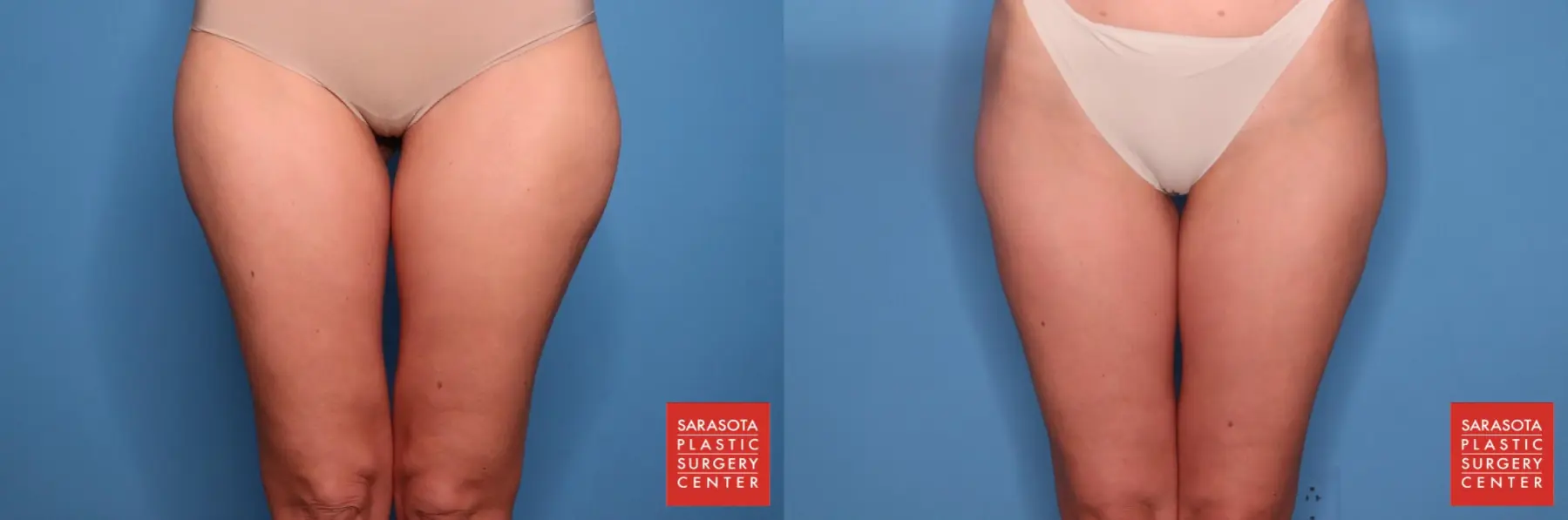 Liposuction: Patient 1 - Before and After  