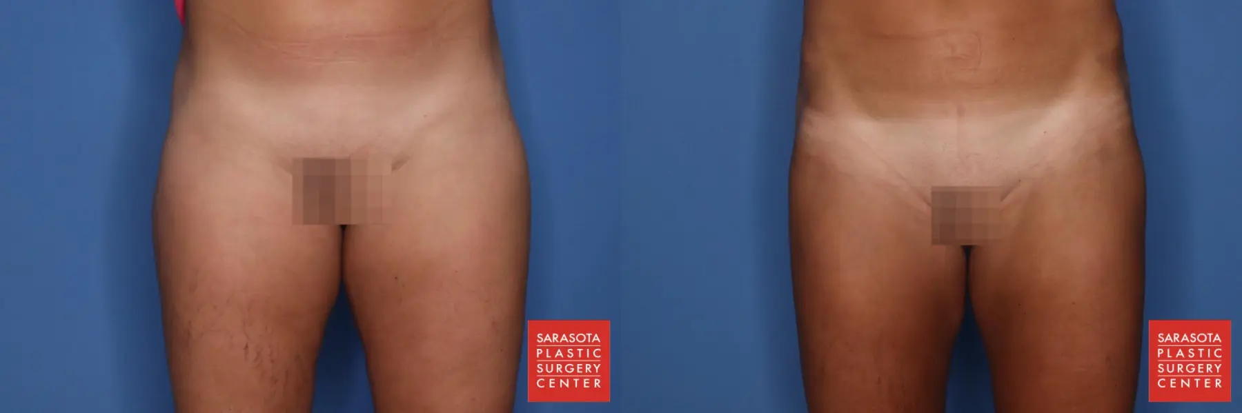 Liposuction: Patient 1 - Before and After  