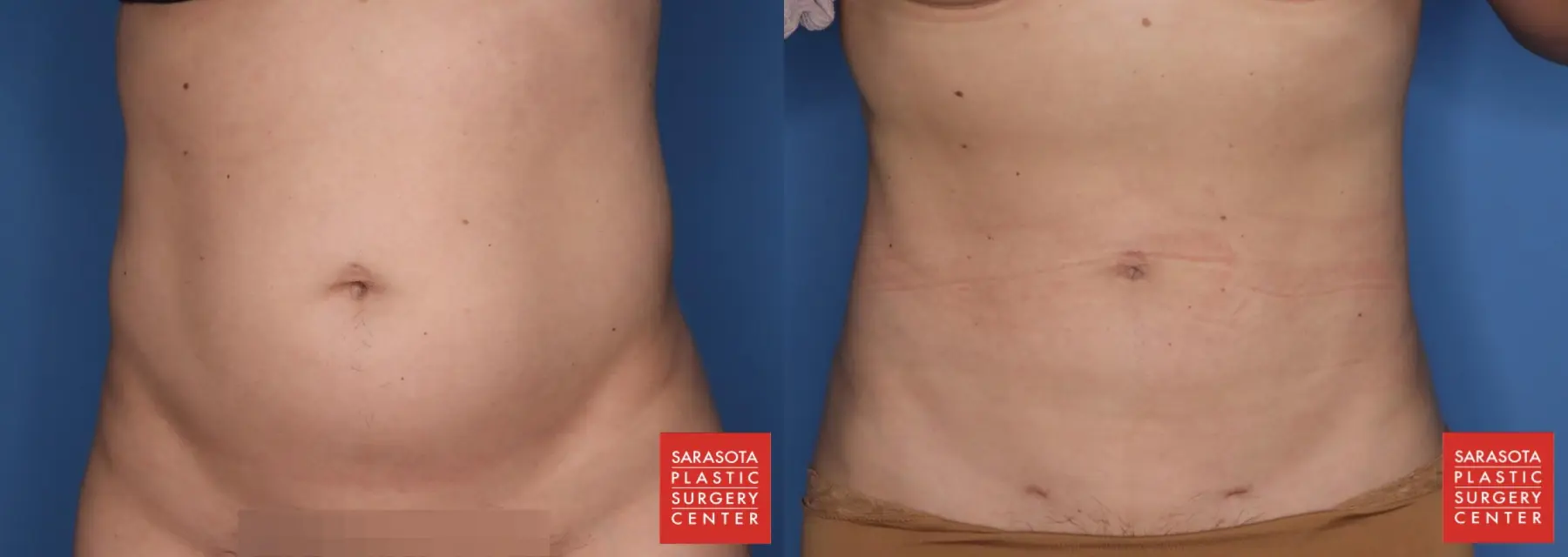 Liposuction: Patient 6 - Before and After  