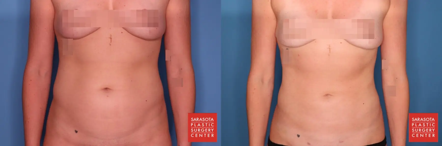 Liposuction: Patient 5 - Before and After  