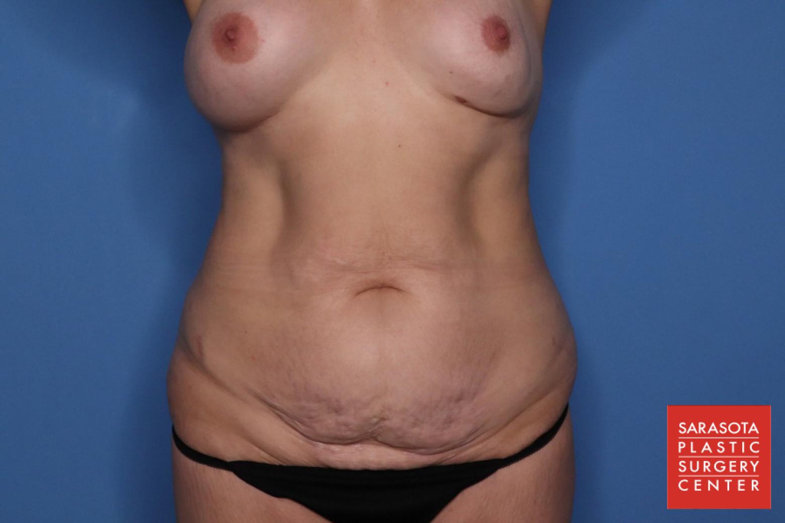 Abdominoplasty: Patient 6 - Before 