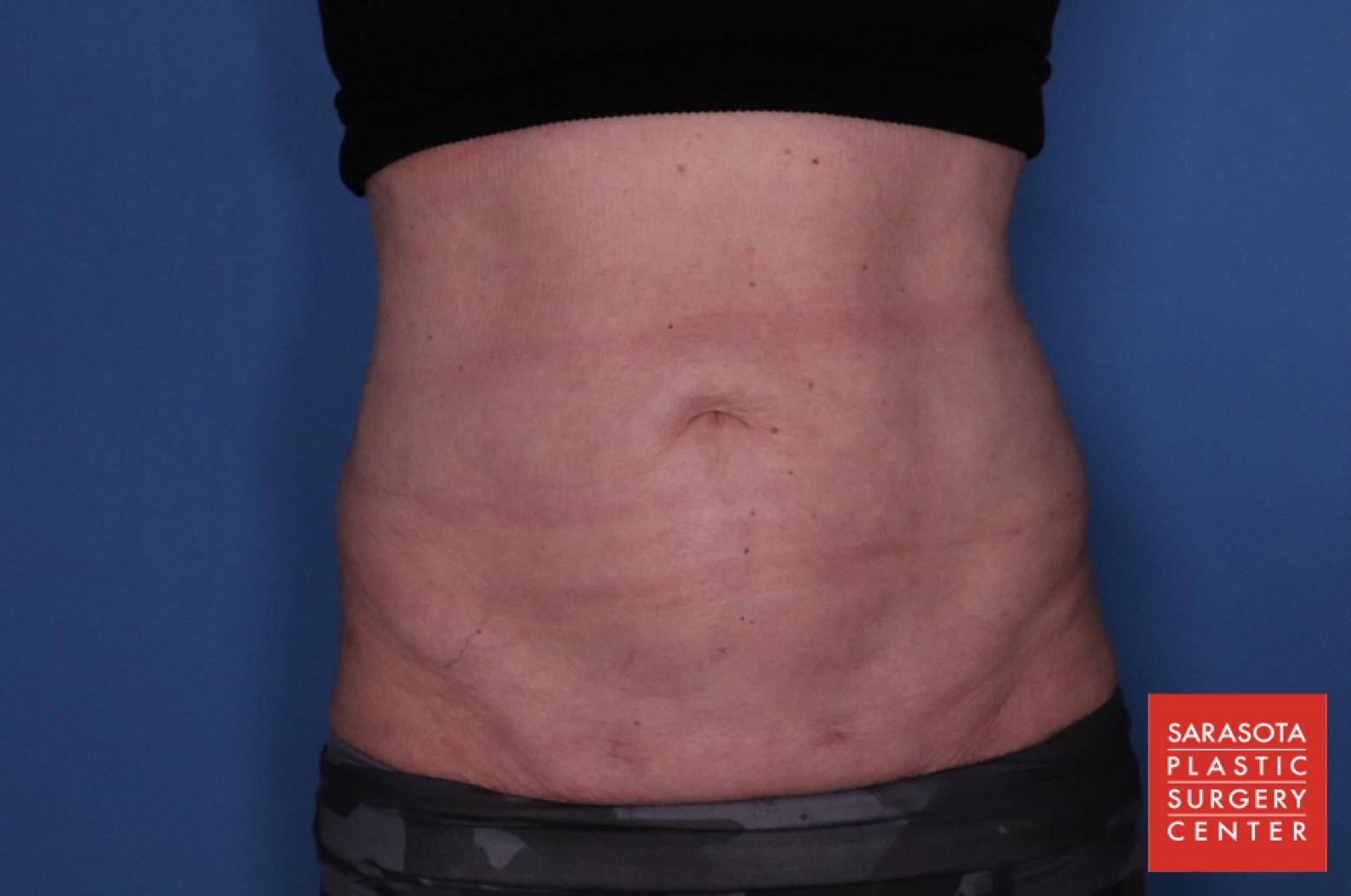 Liposuction: Patient 2 - After  