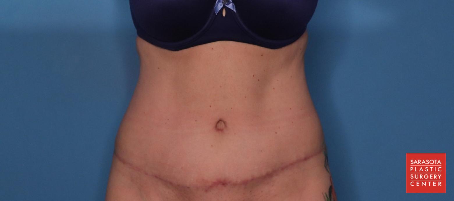 Abdominoplasty: Patient 2 - After  