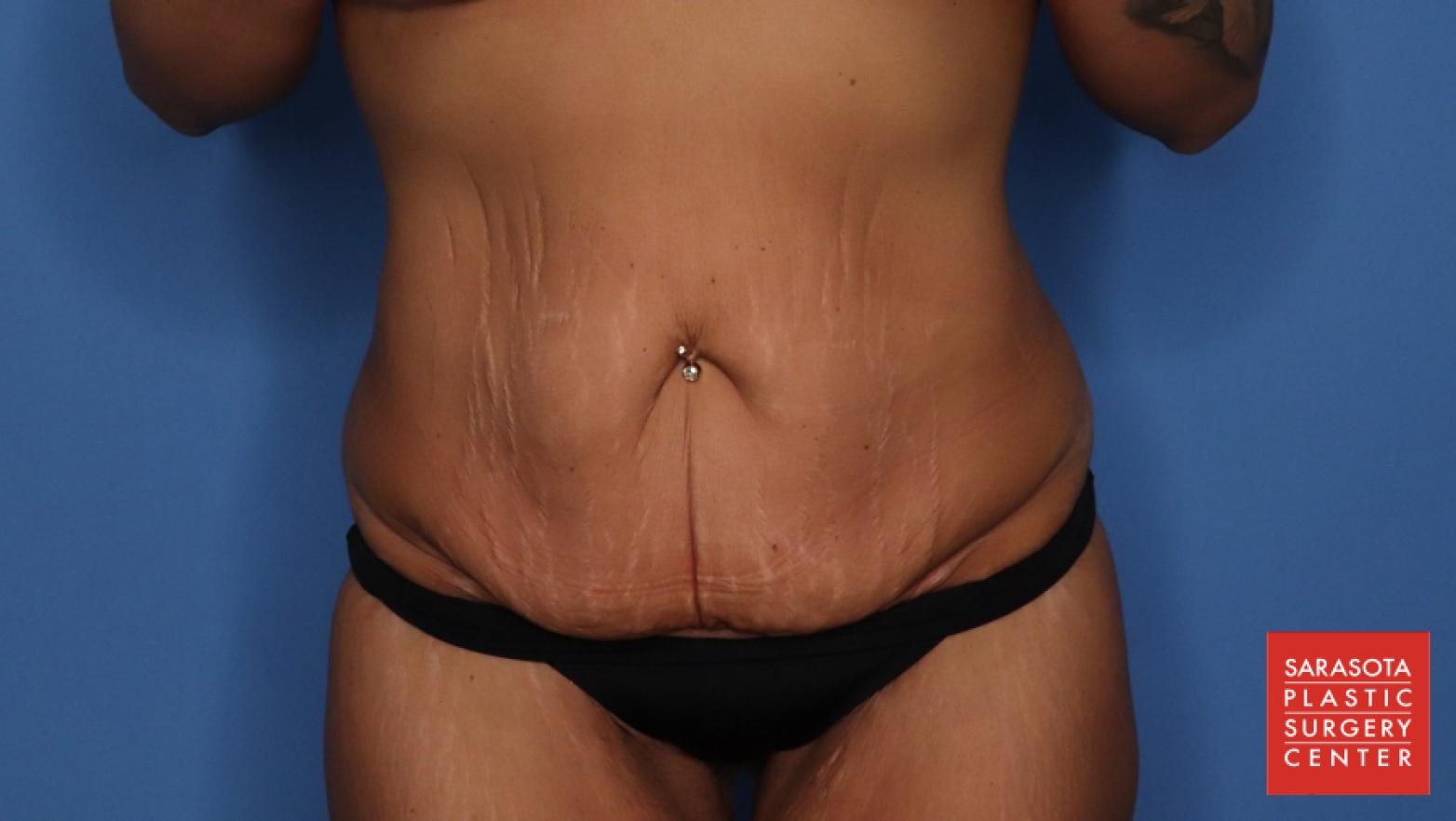 Abdominoplasty: Patient 4 - Before 