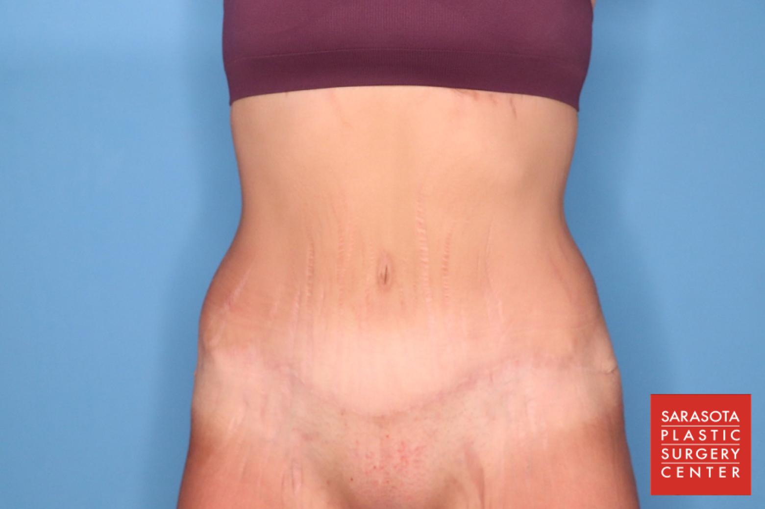 Abdominoplasty: Patient 3 - After  
