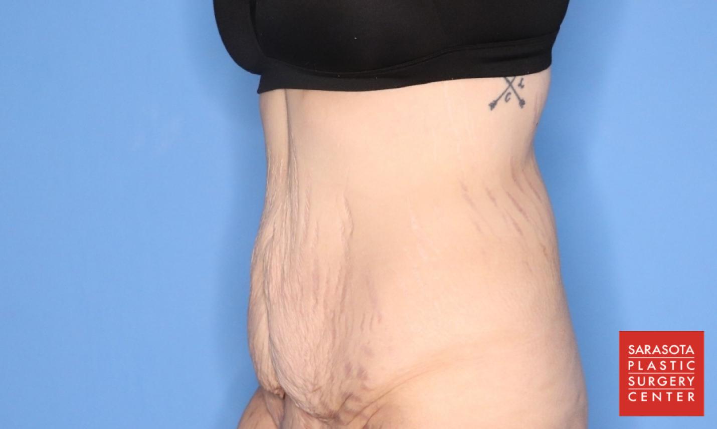 Abdominoplasty: Patient 3 - Before 4