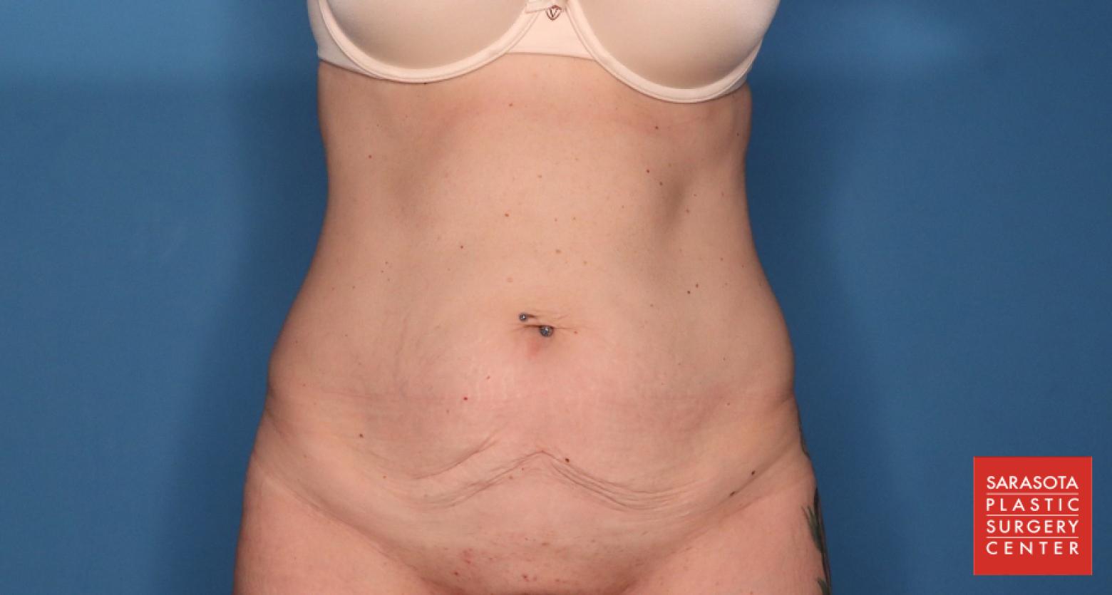 Abdominoplasty: Patient 2 - Before 