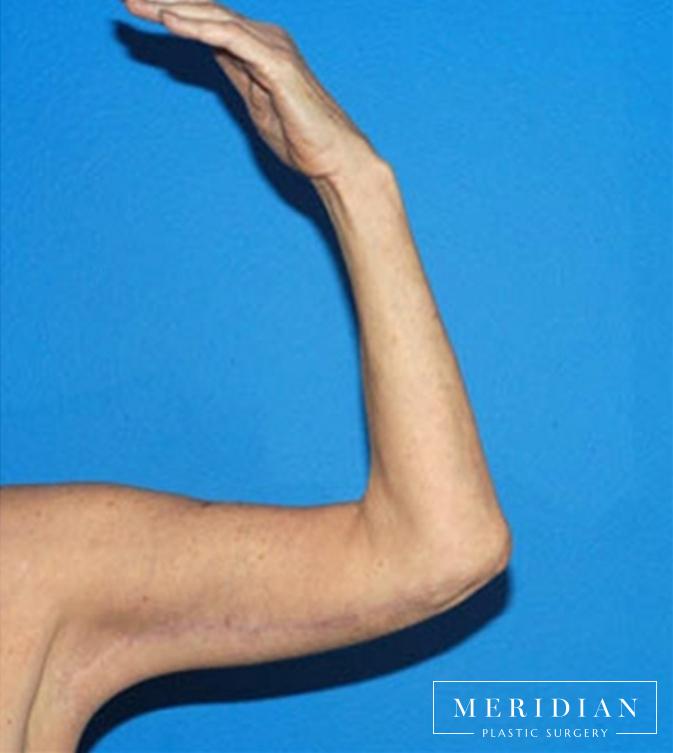 Body Contouring: Patient 14 - After 
