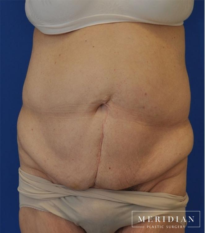 Tummy Tuck: Patient 17 - Before 