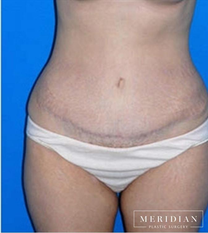 Tummy Tuck: Patient 12 - After 
