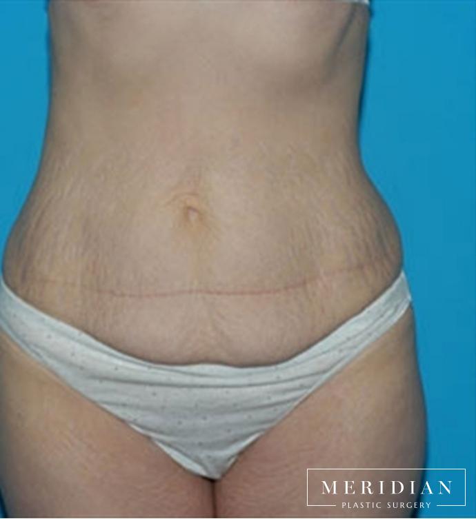 Tummy Tuck: Patient 12 - Before 