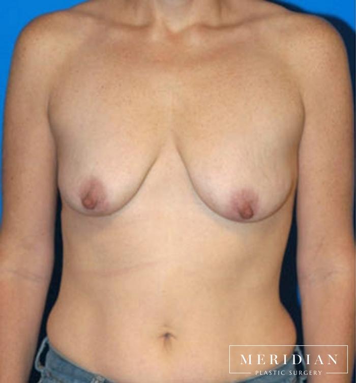 Breast Lift: Patient 12 - Before 