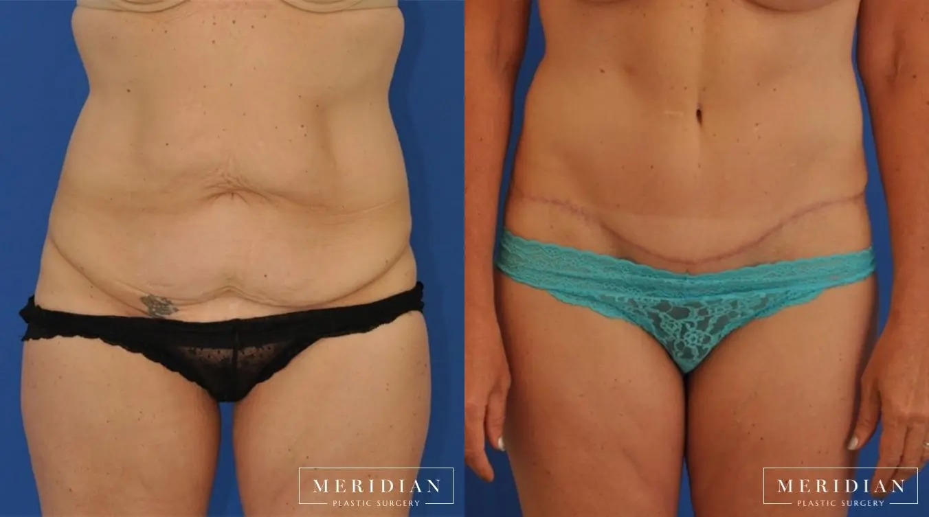 Body Contouring: Patient 12 - Before and After  