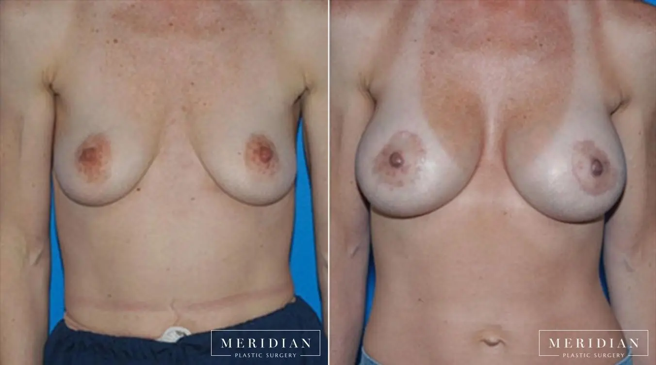 Body Contouring: Patient 20 - Before and After  