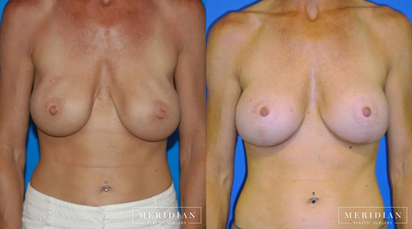 Body Contouring: Patient 21 - Before and After  