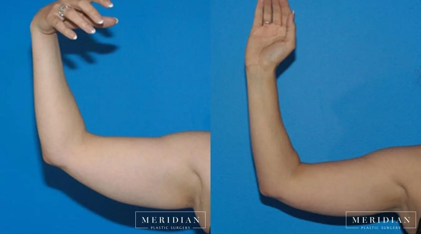 Body Contouring: Patient 15 - Before and After  