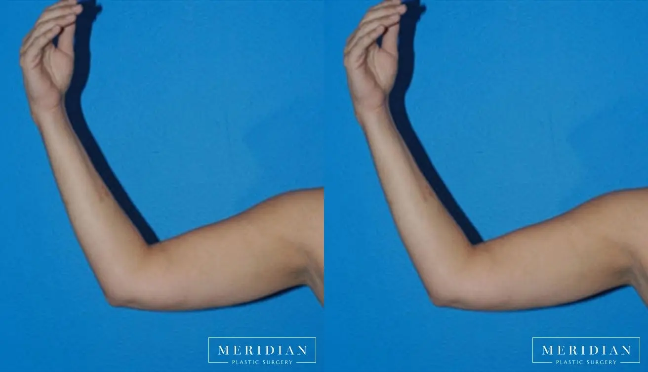 Body Contouring: Patient 16 - Before and After  