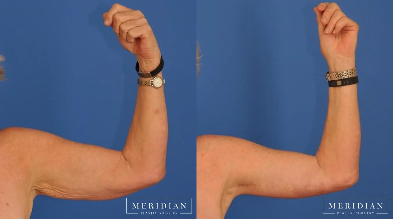 Body Contouring: Patient 18 - Before and After  