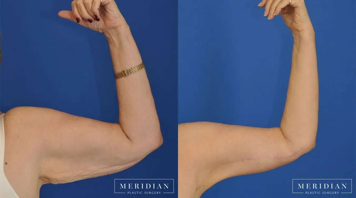 Body Contouring: Patient 17 - Before and After  