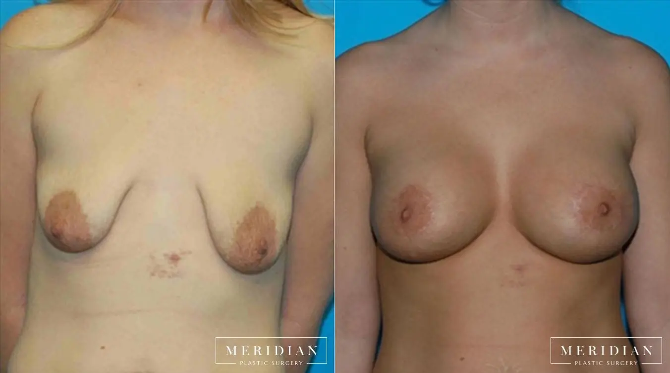 Body Contouring: Patient 25 - Before and After  
