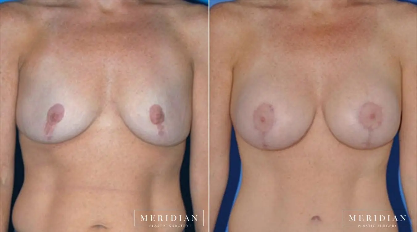 Body Contouring: Patient 22 - Before and After  