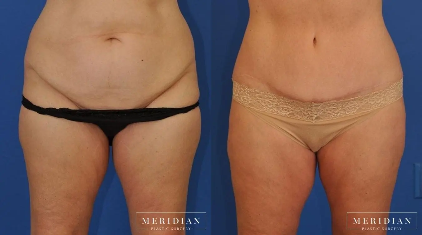 Body Contouring: Patient 26 - Before and After  