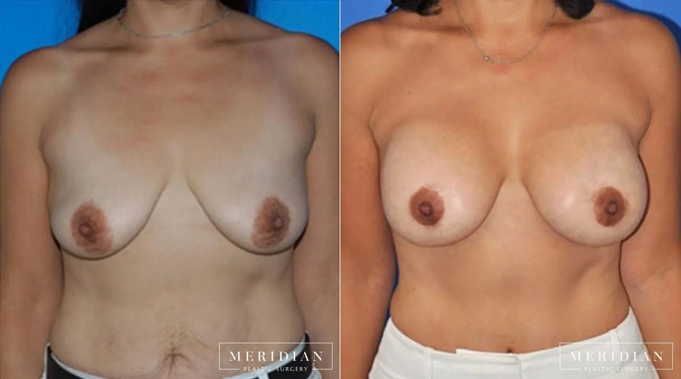 Body Contouring: Patient 23 - Before and After  