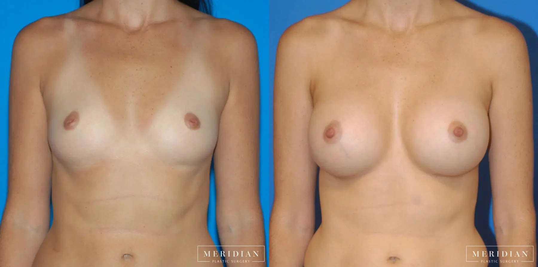 Breast Augmentation: Patient 14 - Before and After  
