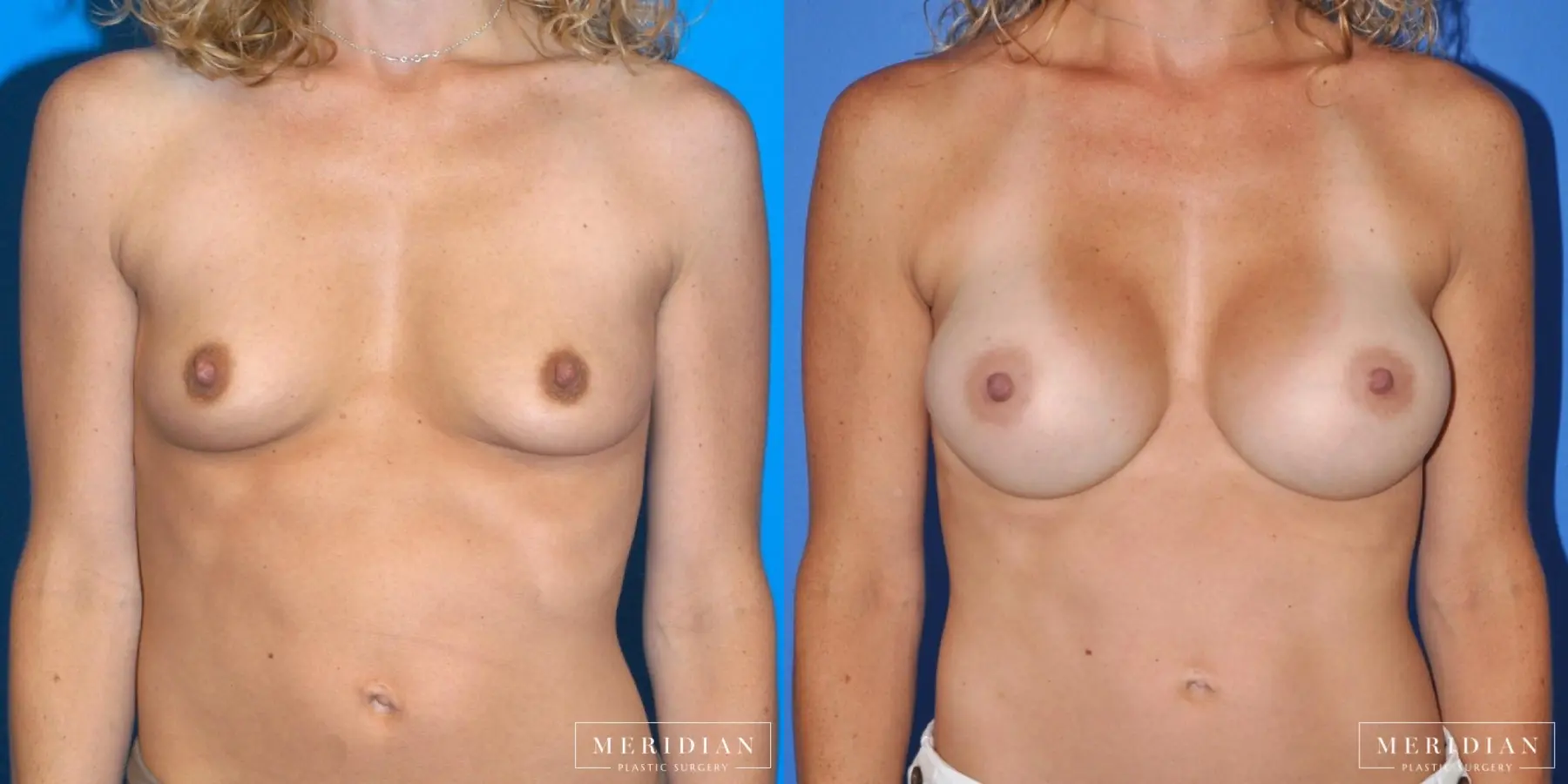 Breast Augmentation: Patient 18 - Before and After  